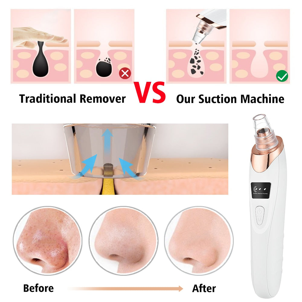 Electric Vacuum Blackhead Remover